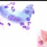 Διογκωμενοι αρραιοχρωματικοι πυρήνες, κυτταρόπλασμα λείπει, ισως πυρήνες αδενικων κυττάρων, πολυπύρηνο επιφ. κύτταρο. 1997